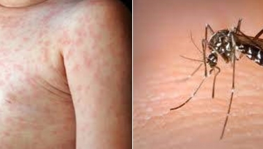 Sốt xuất huyết Dengue - Những điều cần biết về bệnh nguy hiểm này và cách phòng tránh hiệu quả Sốt xuất huyết Dengue