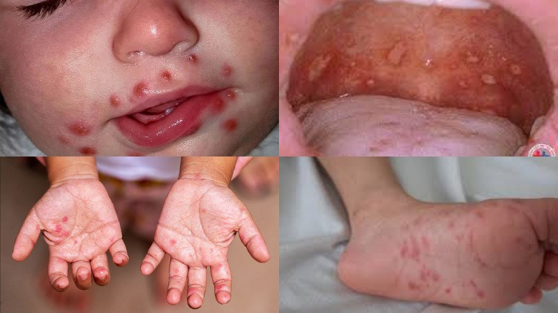 Bệnh tay, chân, miệng - nguyên nhân, triệu chứng, cách chẩn đoán và điều trị hiệu quả cho mọi lứa tuổi Bệnh tay, chân, miệng - nguyên nhân, triệu chứng, cách chẩn đoán và điều trị hiệu quả cho mọi lứa tuổi
